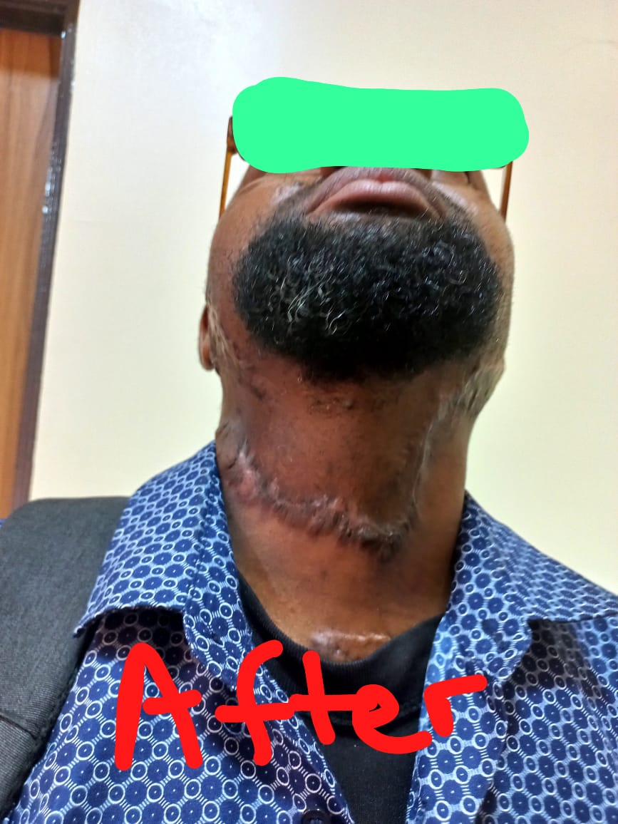After: Excision of Neck Tumour